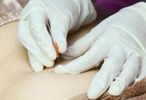 Cấy chỉ điều trị đau nhức