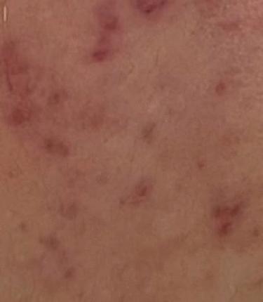 Những biến chứng da thường gặp do mỹ phẩm