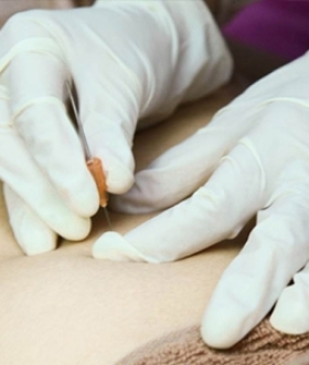 Cấy chỉ điều trị đau nhức